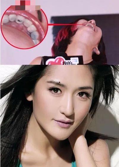 明星有蛀牙吗,揭秘明星口腔健康之谜